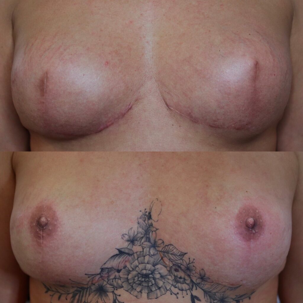 Areola Tattoos