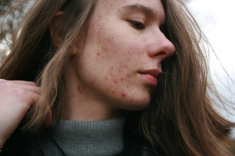 woman with acne