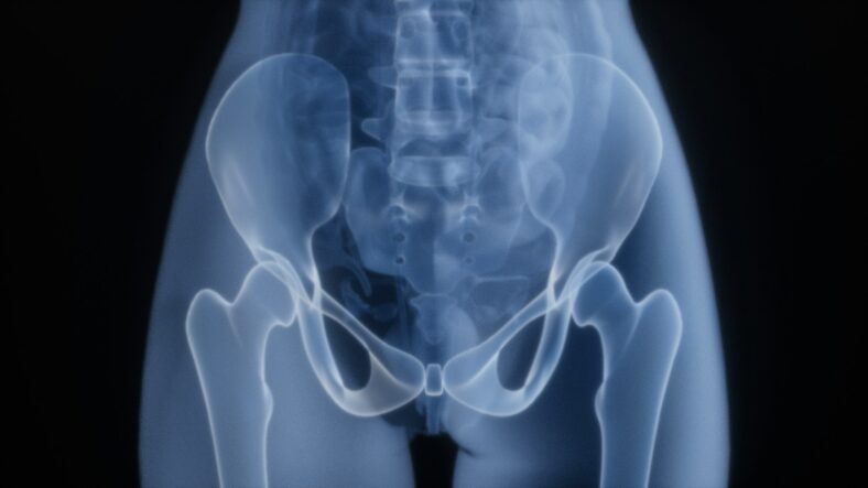 pelvis xray
