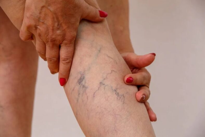 varicose veins on leg